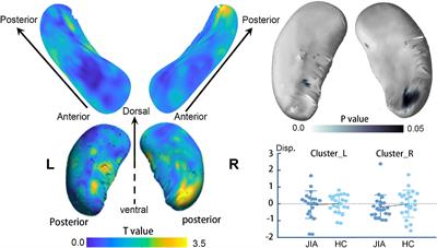 The Brain Structural-Functional Vulnerability in Drug-Naive Children With Juvenile Idiopathic Arthritis: Insights From the Hippocampus